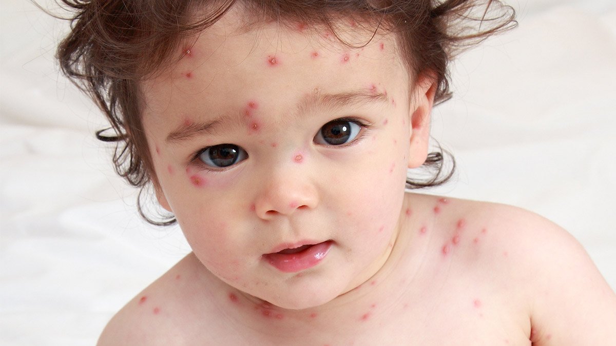 Home Remedies for Chickenpox.